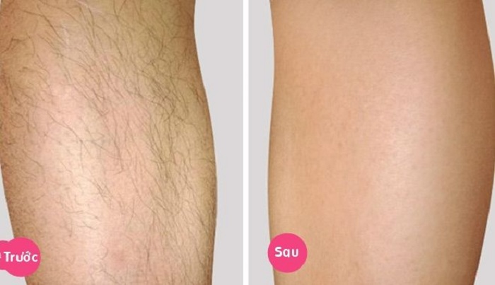 Trước và sau khi tẩy lông chân bằng dầu dừa
